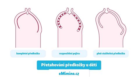 fotografie: jemné čištění předkožky u kojenců (ilustrativní)