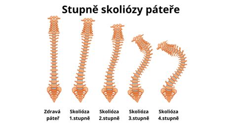 schéma skoliózy páteře