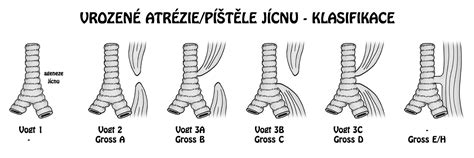 schéma znázorňující atrézii jícnu s tracheoezofageální píštělí