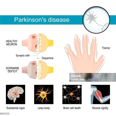 infografika s příznaky DRESS syndromu a závažných kožních reakcí