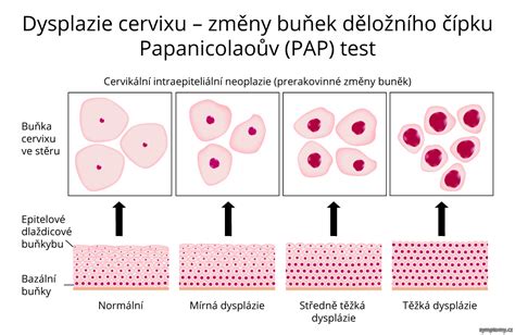 Schéma zobrazující různé stupně abnormálních buněk na děložním čípku.