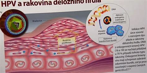 Shema znázorňující vztah mezi HPV infekcí, prekancerózními změnami a rakovinou děložního čípku.