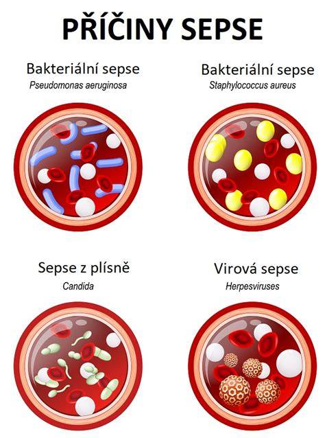 Schéma léčby neonatální sepse: antibiotika, podpůrná terapie, monitorování.