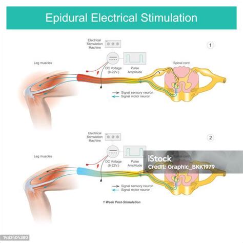 Infografika znázorňující mechanismus katodové stimulace svalů