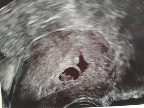 Ultrasonografický snímek plodového vejce s hyperechogenním lemem.