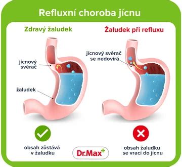 Infografika: Mechanická ochrana jícnu a role alginátu při refluxu