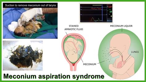 Schéma znázorňující mechanismus syndromu aspirace mekonia