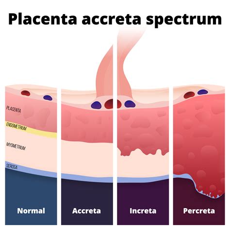 Schéma plánované operace u placenta accreta/increta/percreta
