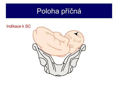 grafické znázornění různých poloh plodu v děloze (podélná hlavičkou, podélná koncem pánevním, příčná, šikmá)