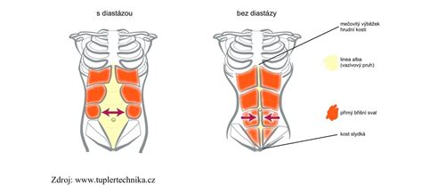schéma zobrazující linea alba a rozestup břišních svalů