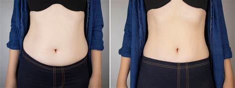 Porovnání břicha před a po abdominoplastice