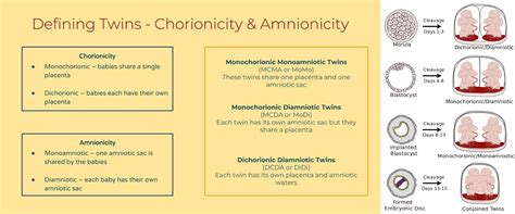 Infografika: Typy dvojčat podle chorionicity a amnionicity