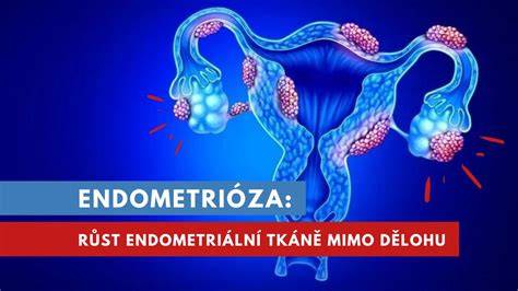 Infografika: Co je endometrióza a kde se nachází