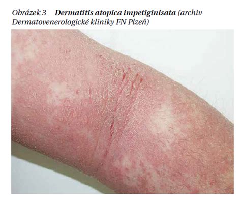 Infografika: Příčiny a faktory atopické dermatitidy