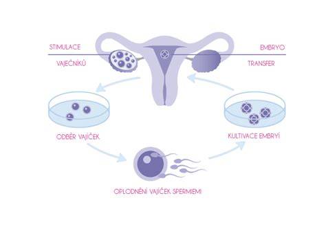 Infografika znázorňující průběh IVF: stimulace, odběr vajíček, fertilizace, kultivace, transfer