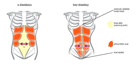 ilustrace znázorňující tlak na břicho během porodu