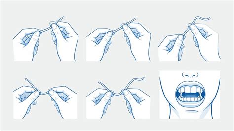 ilustrace správného použití Aniballu