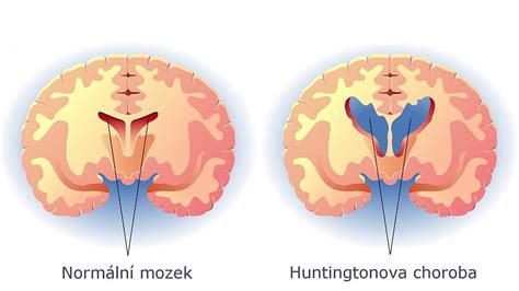 Infografika: Genetika Huntingtonovy choroby a mechanismus mutace CAG