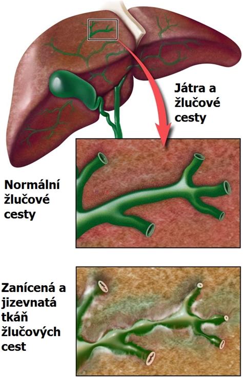Schéma rozkladu bilirubinu a cest žluči