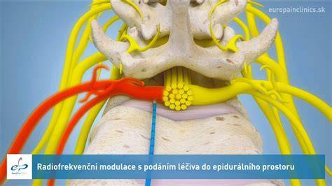 Mapa používaných oblastí vpichu a anatomie epidurálního prostoru