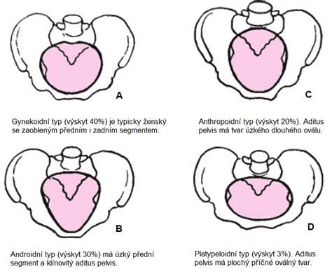 ilustrace ženské pánve s vyznačenou oblastí hráze