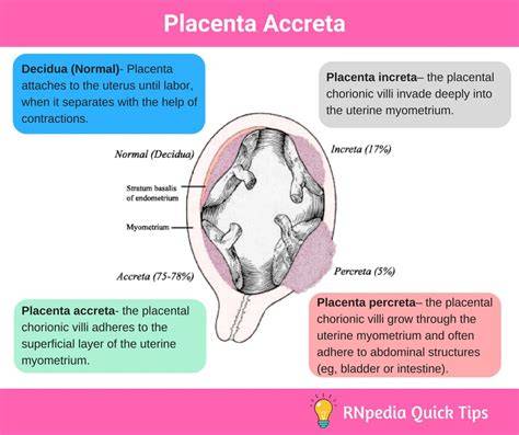 Infografika: Schéma invaze placenta do děložní stěny (placenta accreta/increta/percreta)