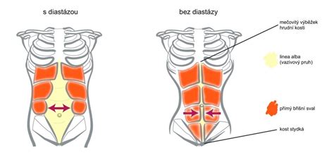 Schéma svalů břišní stěny a znázornění diastázy