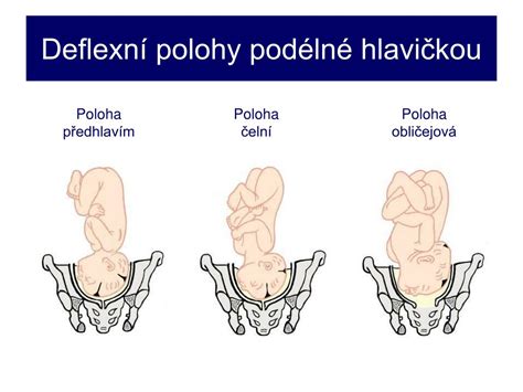 infografika zobrazující různé polohy plodu v děloze