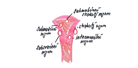 Diagram: Rozdílná lokalizace myomů v děloze