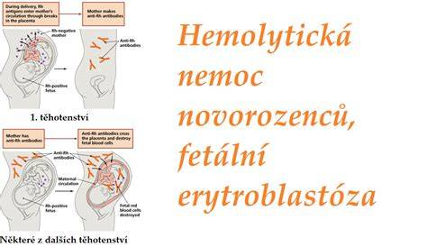 Infografika znázorňující mechanismus Rh inkompatibility a průběhu hemolytické nemoci novorozenců