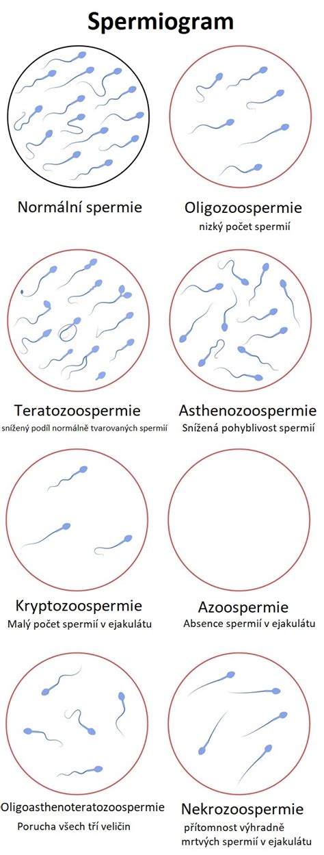 Infografika: Jak se provádí spermiogram a co hodnotí WHO