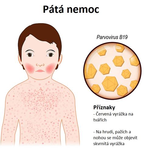 Ilustrace typické vyrážky u páté nemoci