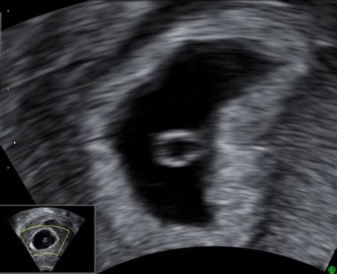 Ultrazvukový snímek plodu v 6. týdnu těhotenství s viditelnou srdeční akcí