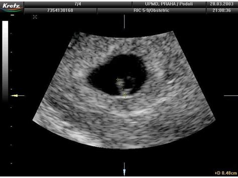 Ilustrace ultrazvukového snímku plodu v prvním trimestru