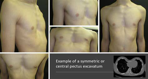 Infografika: Pectus excavatum - anatomie a možné souvislosti