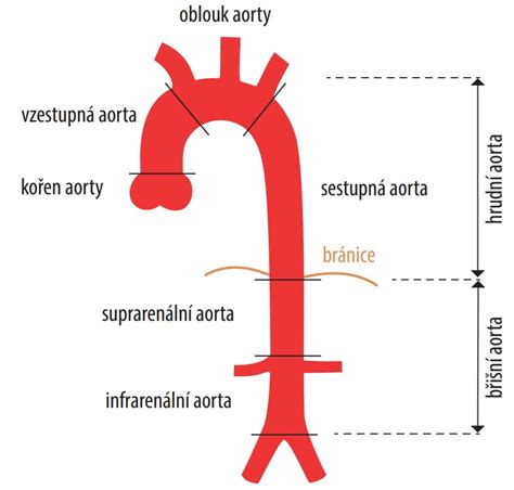 schematické znázornění břišní stěny s vyznačením oslabených míst a tlaku