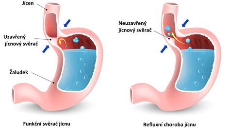 schéma ukazující reflux, kde žaludeční kyselina stoupá do jícnu
