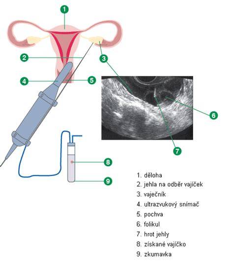 schéma postupu IVF: stimulace, odběr vajíček, oplodnění, kultivace, embryotransfer