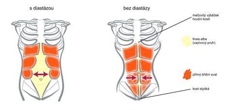 Porovnání normální a kýlní břišní stěny v oblasti třísel