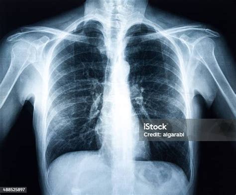 Rentgenový snímek plic pacienta s bakteriální pneumonií.