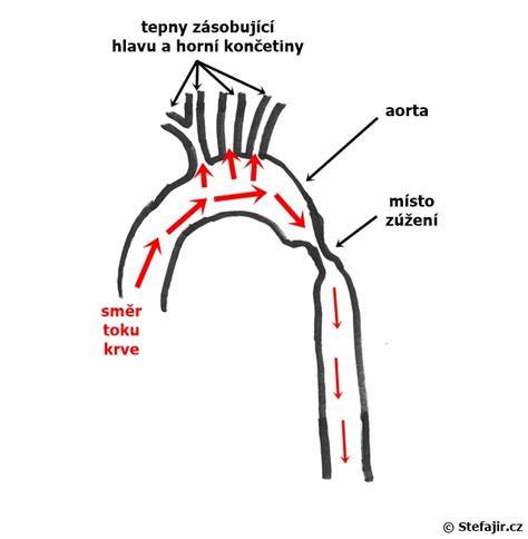 Schéma anatomie aorty a míst koarktace