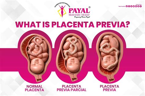 Infografika: Přední placenta previa a rozvrh prenatálních vyšetření