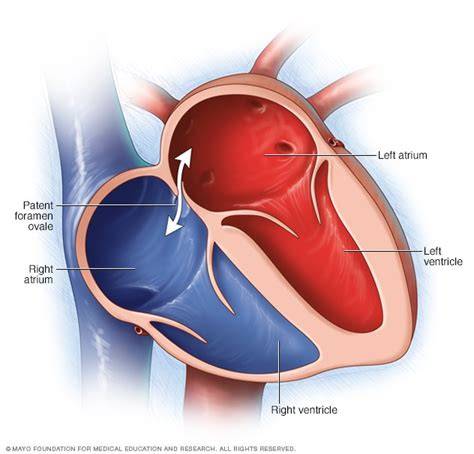 Ilustrace patentního foramen ovale u kojence