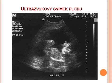 ultrazvukový snímek plodu v děloze