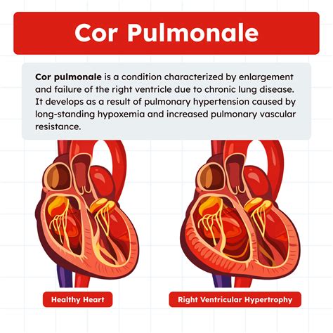 Schéma ukazující patofyziologii vzniku Cor Pulmonale