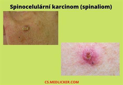Obrázek 3: Bazocelulární karcinom na obličeji