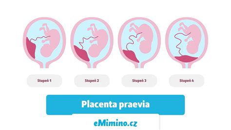 Infografika: typy placenta praevia a postupy léčby