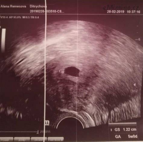 Infografika znázorňující jednotlivé okamžiky viditelnosti gestace na ultrazvuku (5.-6. týden váček, 6.-8. týden embryo a srdeční akce)