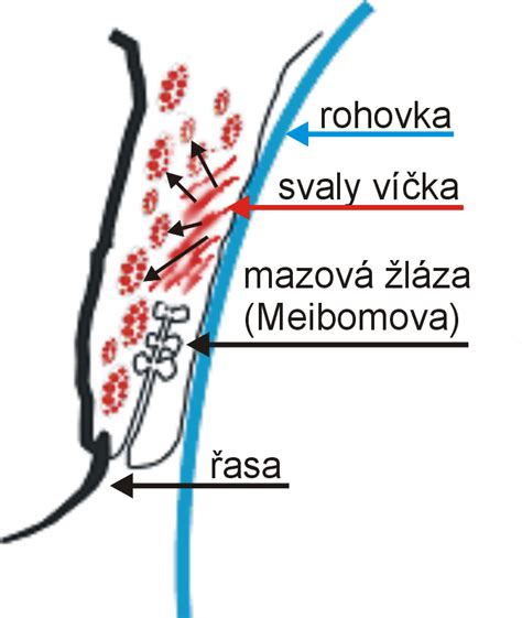 Schéma operačního řezu při císařském řezu.