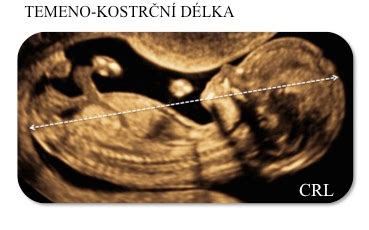 Schéma zobrazující měření CRL (temeno-kostrční délka) plodu ultrazvukem pro určení stáří těhotenství.